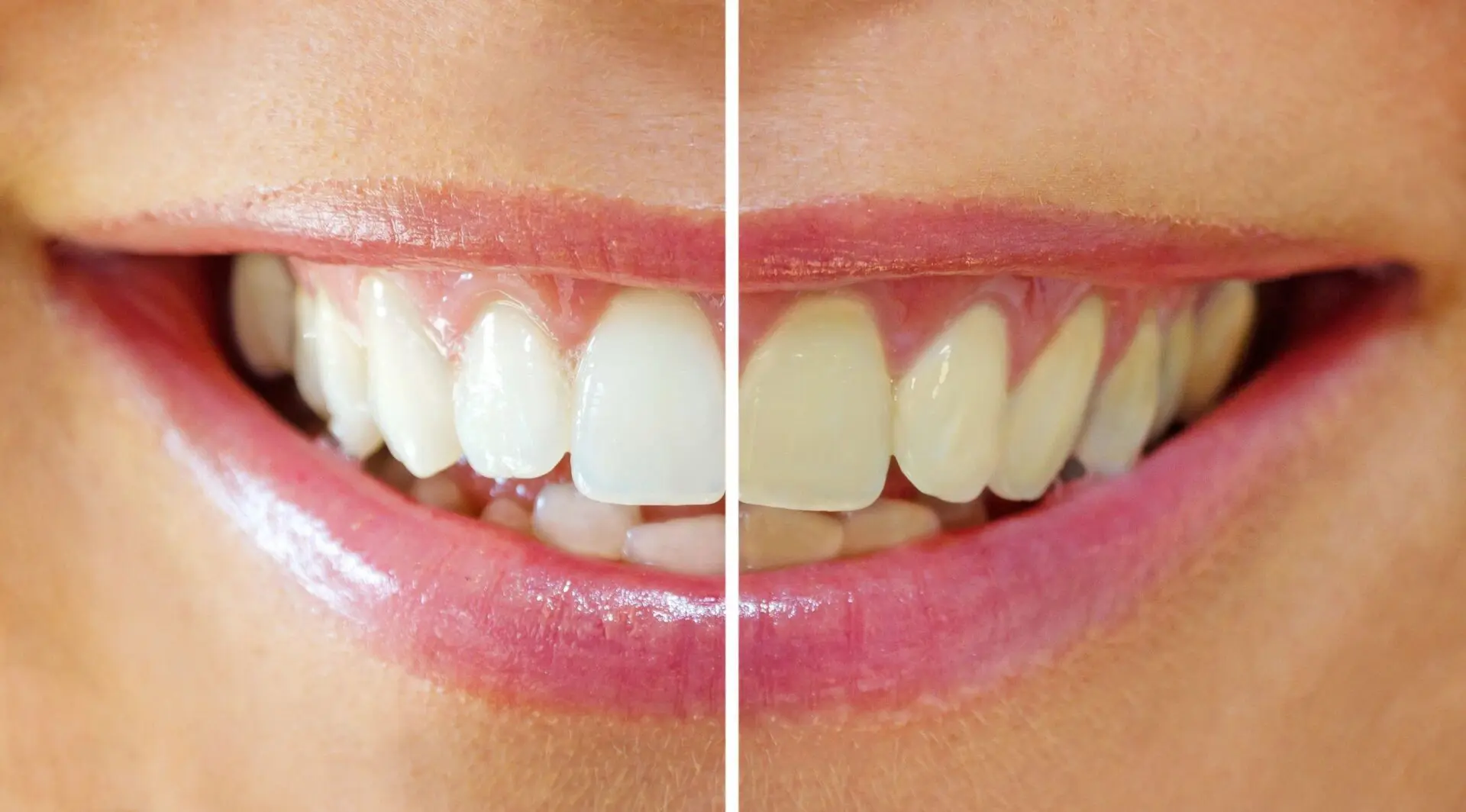 A woman with pink lips and teeth before and after whitening.